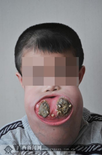 男孩颌骨畸形下颌大如头颅 屡改方案手术成功
