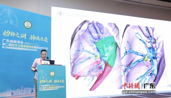 第二届数字三维重建肺癌精准治疗沙龙在广州举行 主办方供图