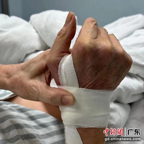 医院在杨老手背的合谷穴区域进行远端桡动脉穿刺，置入颈动脉支架。广东省人民医院供图